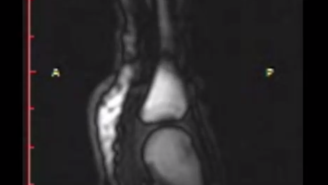 Researchers Used This Live MRI Footage Of A Knuckle Cracking To Disprove A Popular Theory