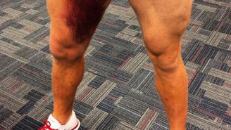 Check Out This Nasty Bruise J.J. Watt Posted On Instagram