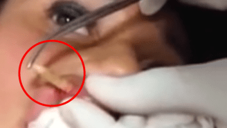 Watch This Woman Have A Giant Botfly Larvae Pulled From Her Lip, If You Can Handle It