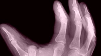 Here’s A UFC Fighter Showing Off A Horrifying X-Ray Of His Broken Thumb