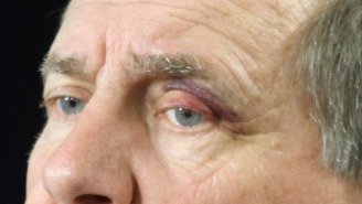 How Did Bill Belichick Get A Black Eye? The Internet Has Ideas