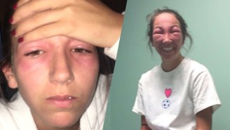 A Girl Got Poison Ivy In Her Eyes And Her Sister Delighted In Her Mutated New Look