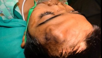 Doctors In India Grew This Kid A New Nose On His Forehead