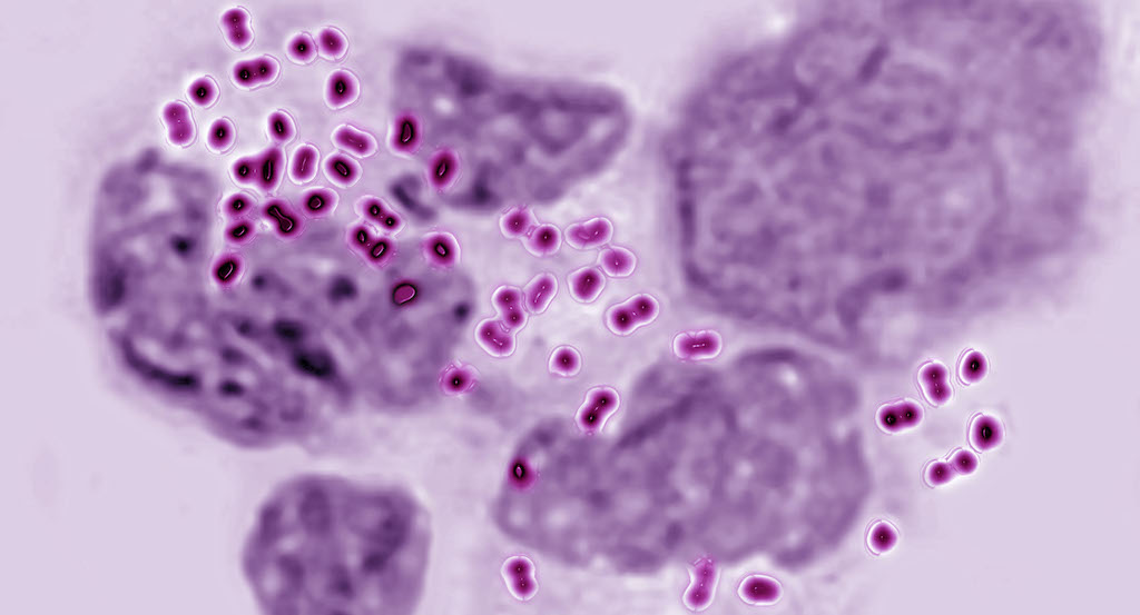 “Super Gonorrhea” is real and has exploded due to COVID-19